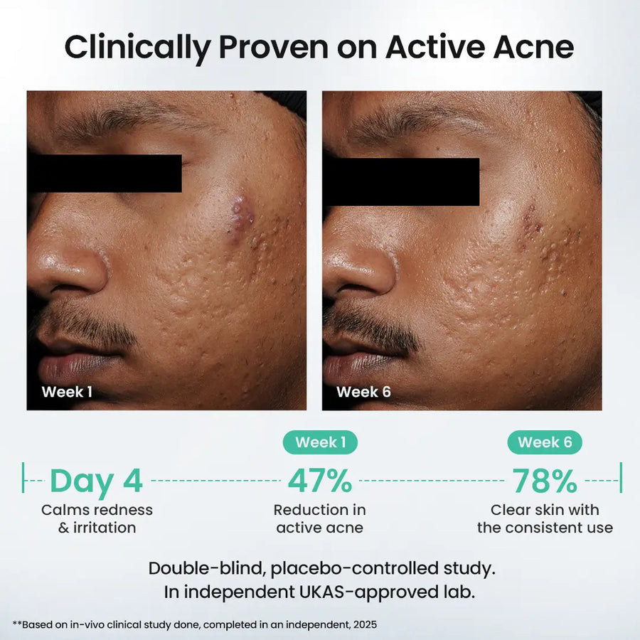 Acne Care Combo Kit
