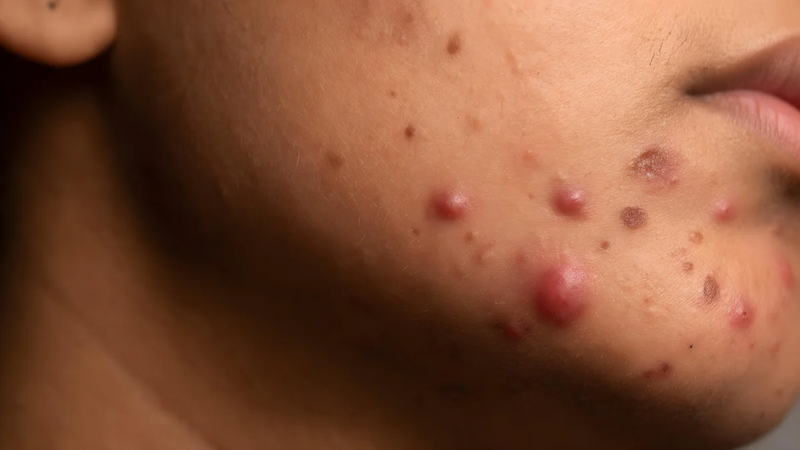 Recurring or hormonal breakouts
