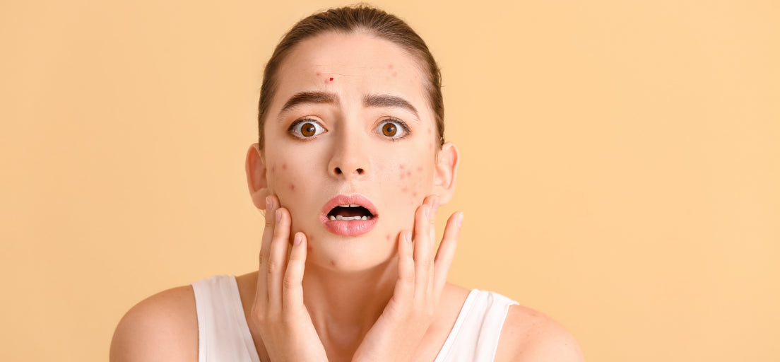 A young professional with acne looks confident at work, smiling while engaging in a meeting.