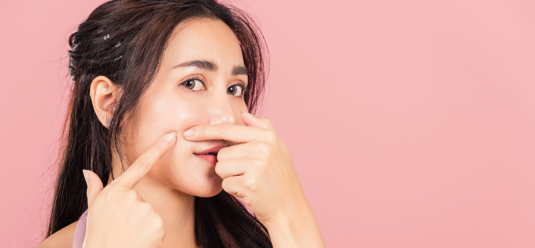 A person applying a natural remedy to their skin to reduce pimple marks and prevent scarring.