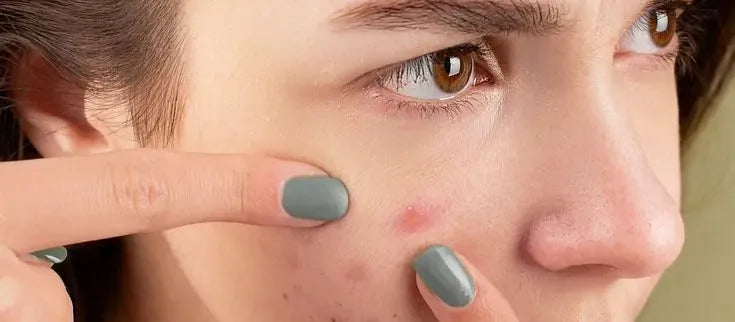 A person applying a natural remedy to their face to quickly remove a pimple within two days.