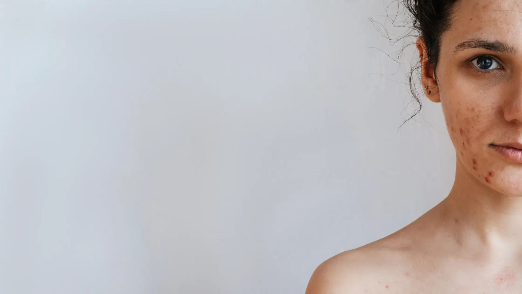 Skin barrier repair for acne-prone skin