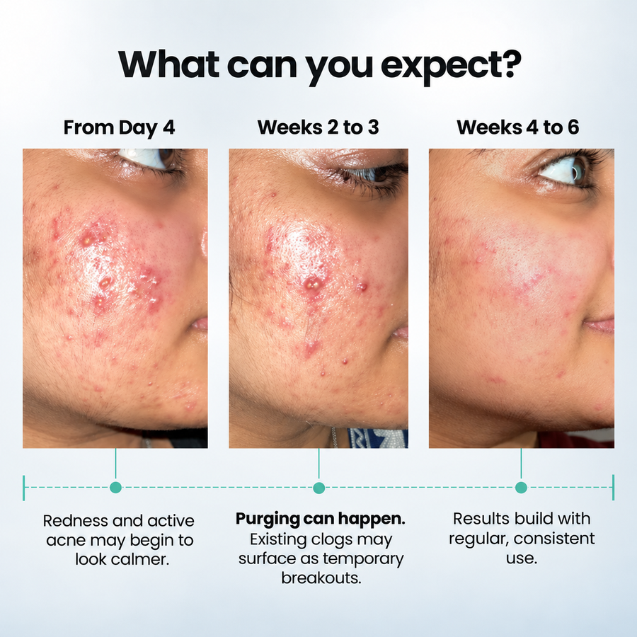 Acne Care Combo Kit