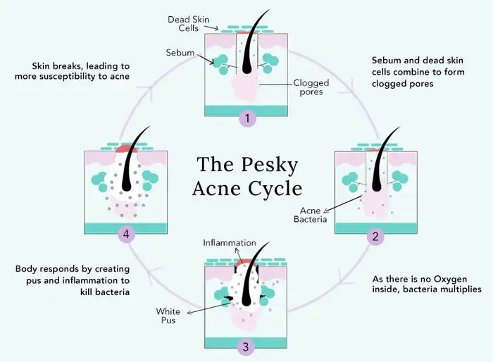 break the acne cycle